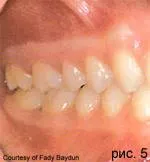 Gyorsan előrehaladó (agresszív) periodontiíissei marginális koncepció gyorsan halad