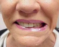 Botulinum toxin Dentistry