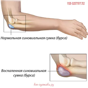 Bursitis könyök kezelés és tünetek