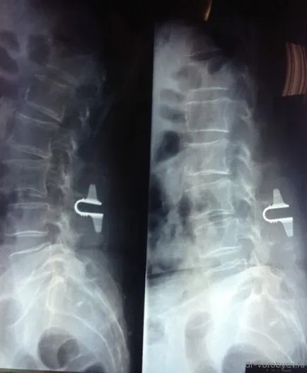 Coflex (kofleks) implant, neurochirurgie