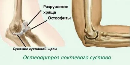 Deformáló osteoarthritis a könyökízület tünetek és a kezelés