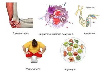 Deformáló osteoarthritis a könyökízület tünetek és a kezelés