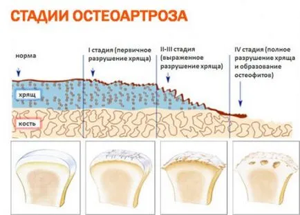 Deformând osteoartrita simptomelor articulare cot și tratament