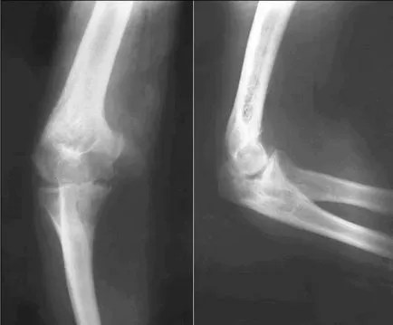 Deformáló osteoarthritis a könyökízület tünetek és a kezelés