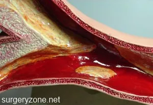 Differenciáldiagnosztikája arteriosclerozis