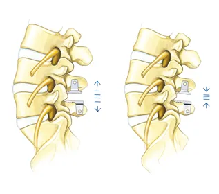 Динамично фиксиране на лумбалните (coflex)