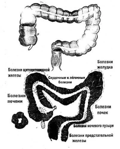 Paralizie cerebrală