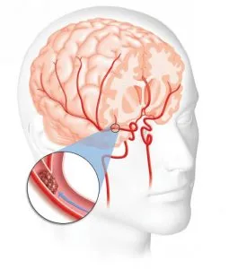 encefalopatie cerebrală la vârstnici - prognosticul și tratamentul