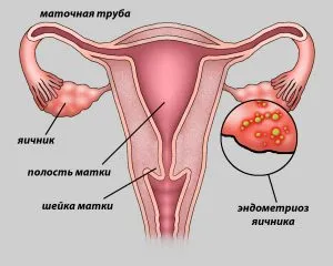 petefészek endometriózis