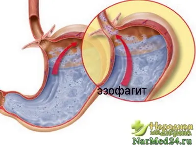 Nyelőcsőgyulladás reflux okok, tünetek és a kezelés a betegség