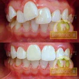 Malocclusion felnőtteknek - az ár a zárójelek kijavítani fogak