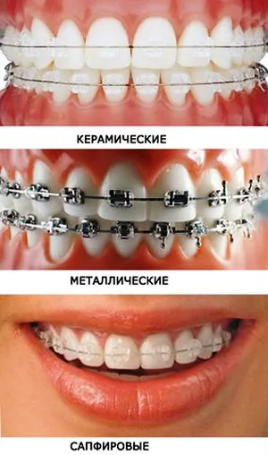 Malocclusion Cheboksary NWR Tsivilsk fém fogszabályozó kerámia zárójelek