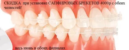 Malocclusion Cheboksary NWR Tsivilsk fém fogszabályozó kerámia zárójelek