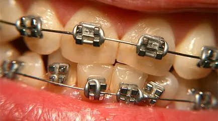 Malocclusion felnőtteknek - kezelésére alkalmas eljárásokat malocclusion