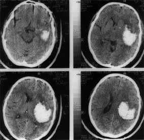 accident vascular cerebral hemoragic