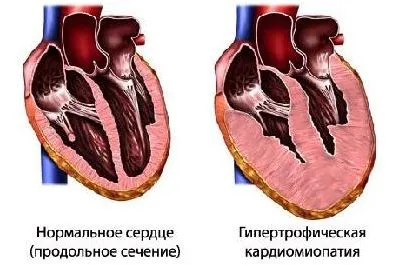 cardiomiopatie hipertrofică