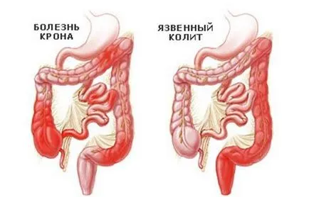 Worms и паразити малки помощници в борбата срещу алергии, улцерозен колит лечение