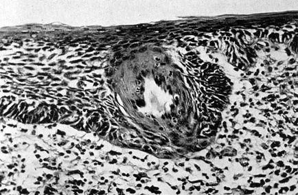 A bazális sejtes hiperplázia