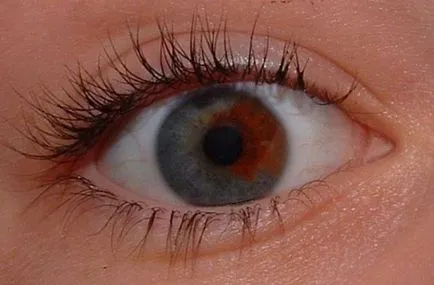 heterochromia emberek