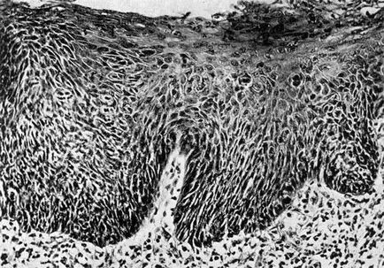 A bazális sejtes hiperplázia