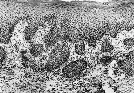 Basal клетъчна хиперплазия