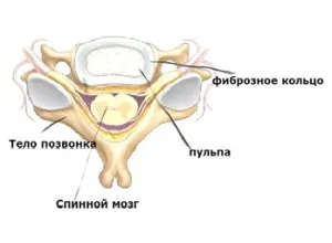 гръбначния херния