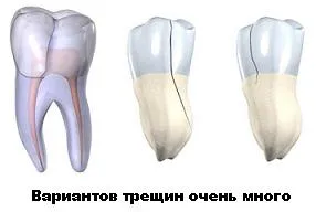 Cum să se ocupe cu fisuri smalțului dentar, perfecțiunea dentare