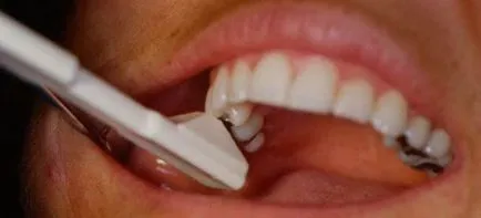 Cum să se ocupe cu fisuri smalțului dentar, perfecțiunea dentare