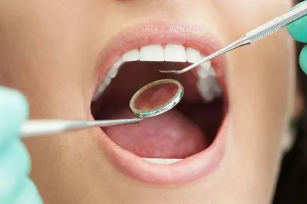 Cum să se ocupe cu fisuri smalțului dentar, perfecțiunea dentare