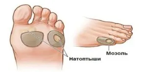 Как да се отървем от мазоли на краката си като у дома си