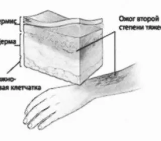 I се обработва за изгаряния