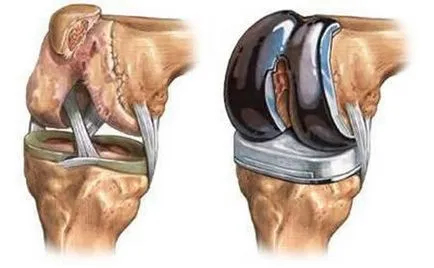 Как да се развива протезата коляно у дома