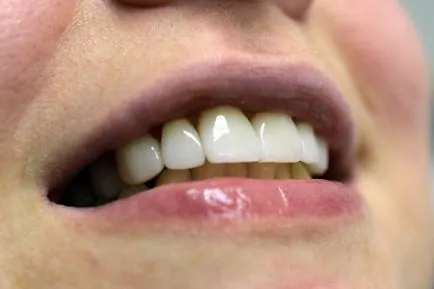 Както фасети крият разликата между зъбите