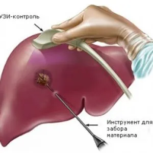 Cauzele chistului si tratamentul ficatului, este chist, dieta, eliminarea hepatică chistului