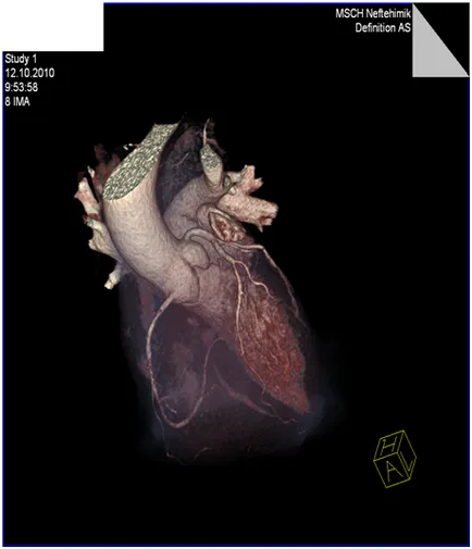 angiografia coronariană neinvazivă - tratamentul inimii