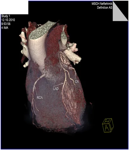 angiografia coronariană neinvazivă - tratamentul inimii