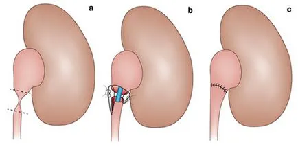 Коя операция в хидронефроза дава най-добри резултати