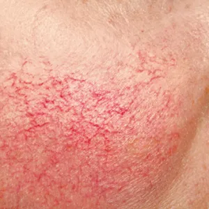 Rosacea az arc - szakszerű kezelésére krémek és eszközöket (Leser, flash, stb