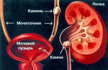 A kezelés a vesekő segítségével vetőmag szilva, Népi orvosi kézikönyv