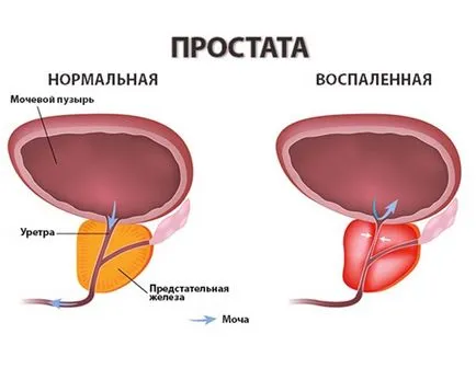 Tratamentul prostatita în Israel, costul, MC izmedic