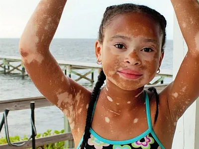 vitiligo kezelés a hazai és hogy lehetséges-e, hogy gyorsan megszabadulni a betegség