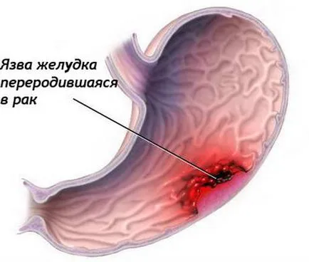 Лимфните възли под мишниците - възпаление, когато лимфните възли под мишниците