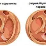 Microtia a fül okoz, tünetek és a kezelés