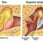 Microtia urechii cauze, simptome și tratament