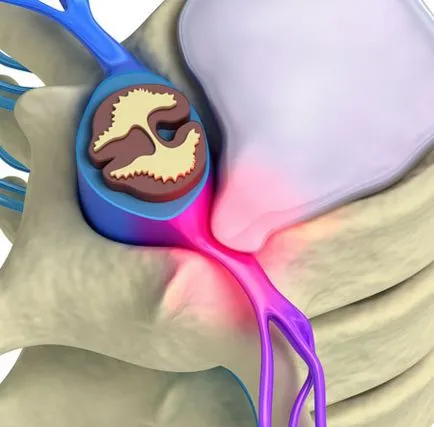 Intervertebral hernie - simptome și măsuri de tratament