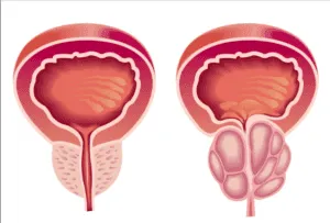 Ce boli afectează impactul potenta, rinichi si psoriazisul potenta, adenom de prostata si