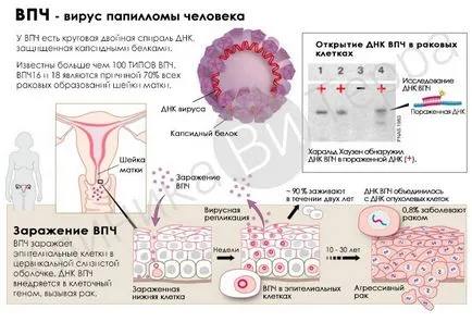 Cum să scapi de remedii populare infecției cu virusul papiloma