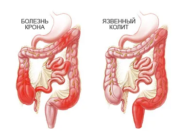 Човек се излекувал от улцерозен колит, поглъщане на яйцата на червеи, meddaily