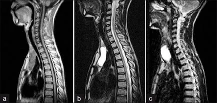 MRI на шийните прешлени