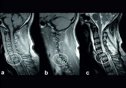 MRI на шийните прешлени